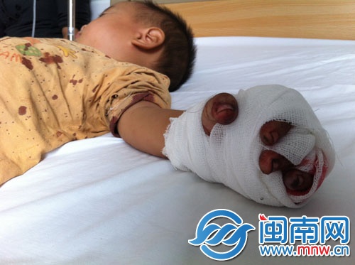 小園的左手無名指被三輪電動(dòng)車鏈條絞斷